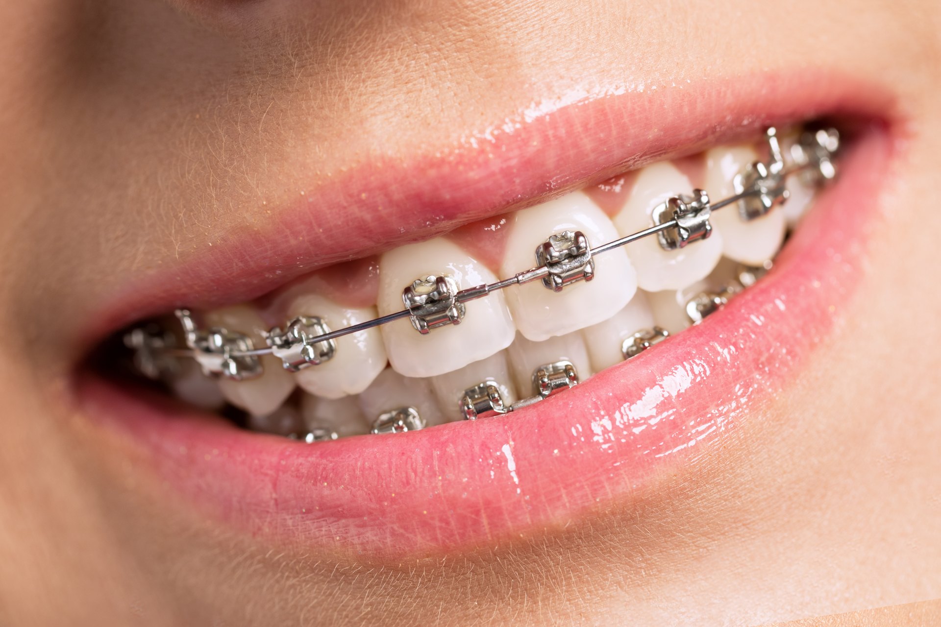 metal-braces