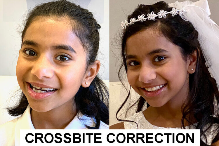 Crossbite Correction