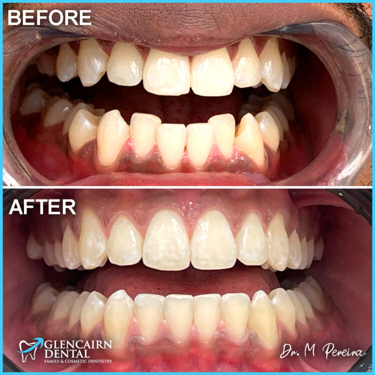 Invisalign Case Study