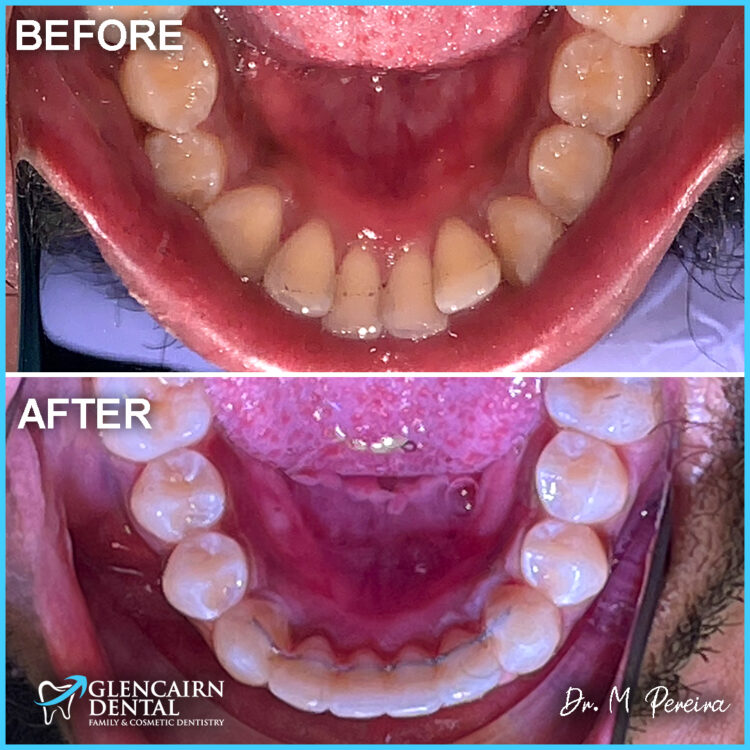 Invisalign Case Study